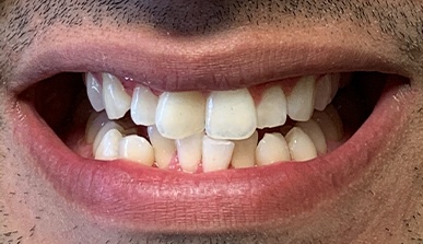 Patient's perfected smile after Invisalign and dental bonding treatment